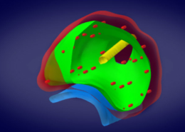 Brachytherapie – Verteilung der Seeds am Beispiel eines 3D-Models