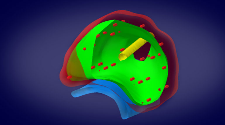 Brachytherapie – Verteilung der Seeds am Beispiel eines 3D-Models